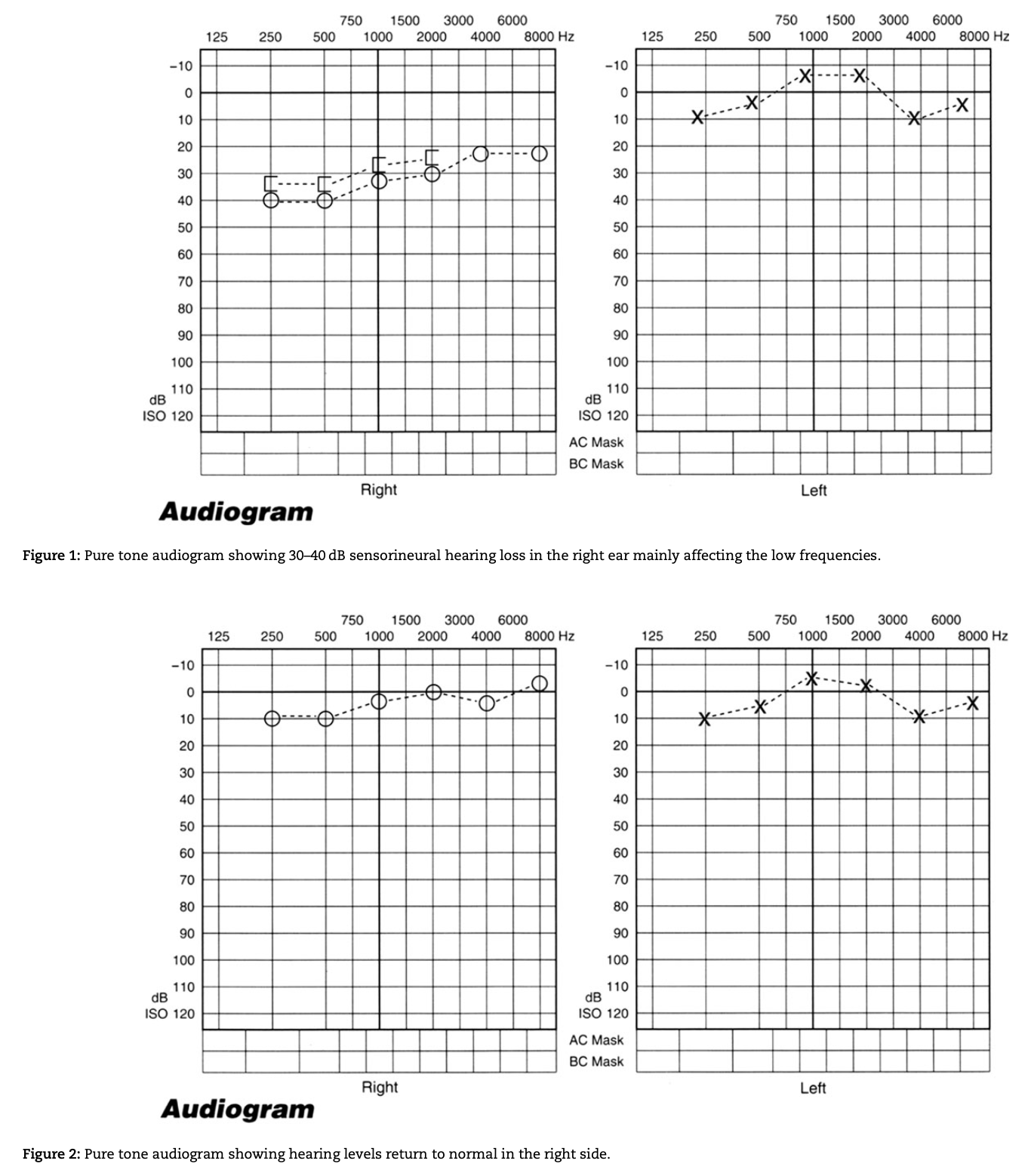 Figure: A case of carbon monoxide intoxication.  The top two panels are an initial audiogram that shows right sided low frequency hearing loss.  The bottom two panels are a subsequent audiogram that shows normalization of hearing.  From Seale et al. (2018).