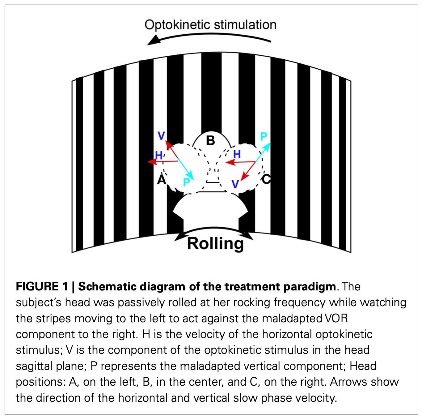 Figure: Illustration of the technique developed by Dr. Mingjia Dai for the treatment of mal de debarquement syndrome.  From Dai et al. (2014).
