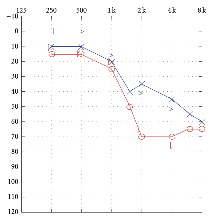 Figure: Right greater than left sided high frequency sensorineural hearing loss in carbon monoxide intoxication.  From Pillon (2012).