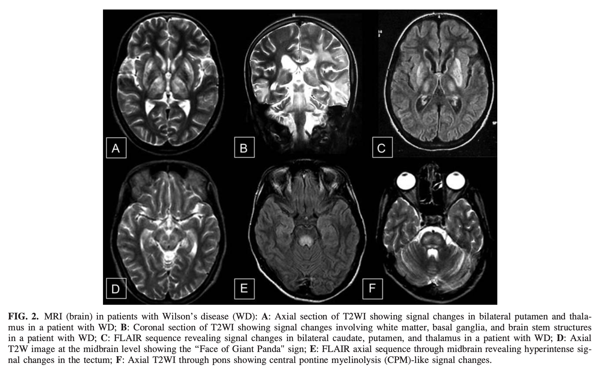 Figure: MRI findings in patients with Wilson's disease.  From Prashanth et al. (2010).