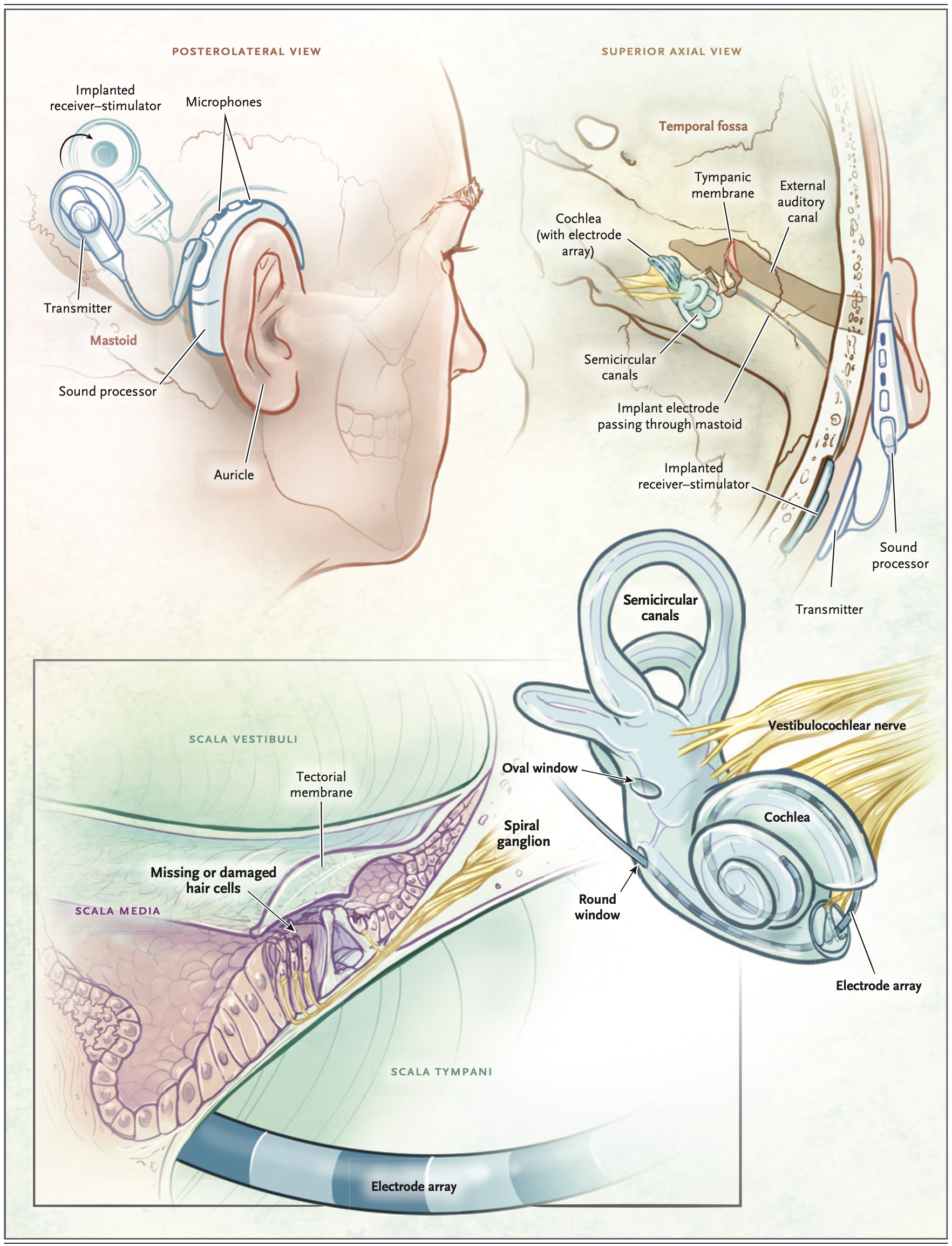 Figure: Cochlear implant disposition.  From Carlson (2020).