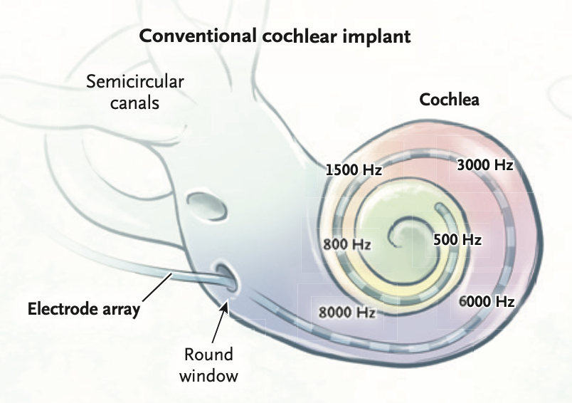 Figure: Cochlear implant electrode passing through the round window, and its disposition within the cochlea.  From Carlson (2020).