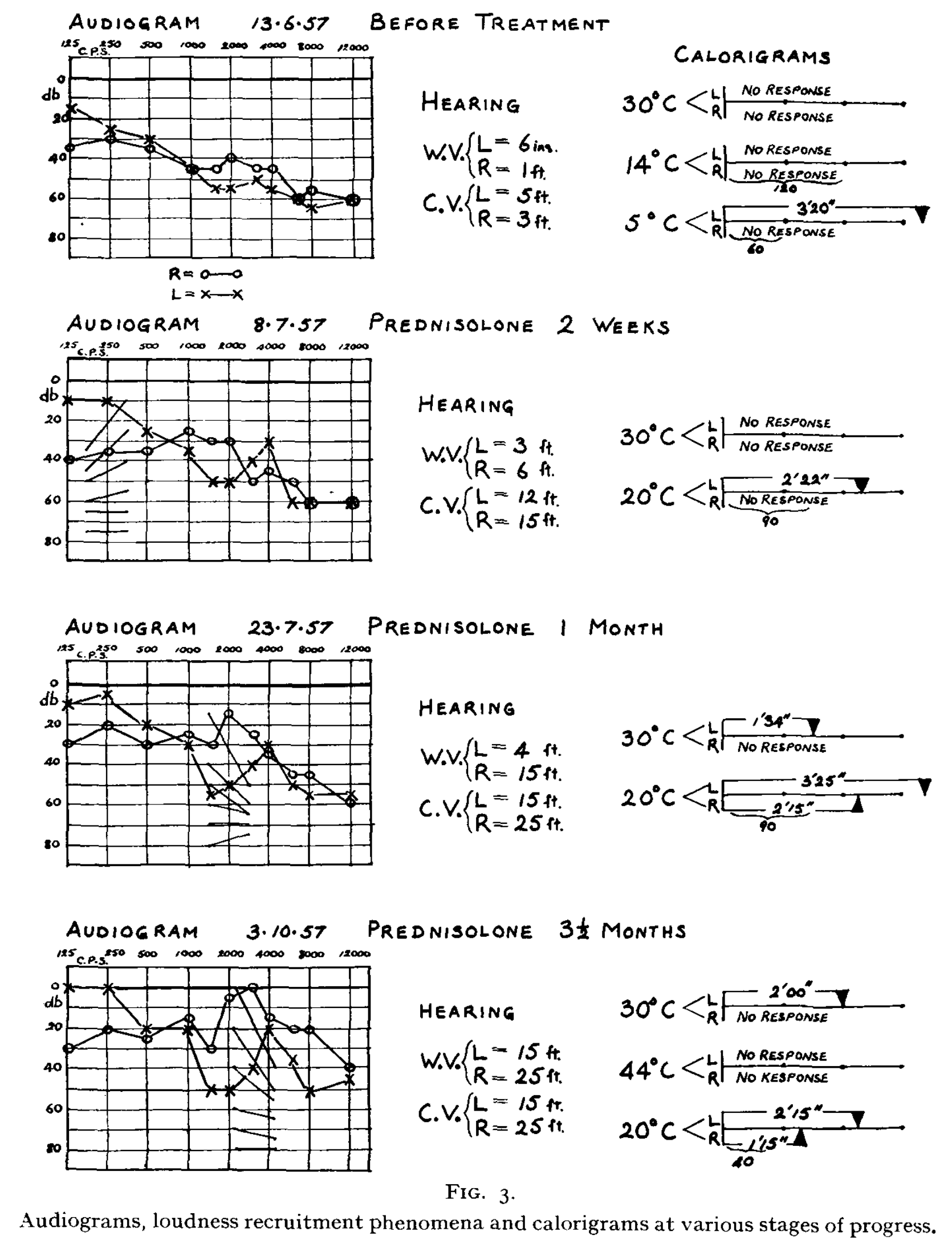 Figure: Improvement in hearing and caloric responses in a neurosarcoidosis patient treated with prednisolone.  From Gristwood (1958).