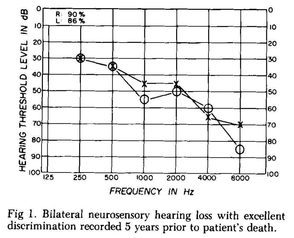 Figure: Typical audiogram from a patient with deafness attributed to neurosarcoidosis.  From Babin et al. (1984).