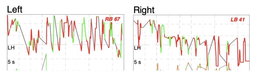 Figure: Centripetal nystagmus in anti-NMDA paraneoplastic syndrome from a mature ovarian teratoma. From Cherchi and Hac (2023).