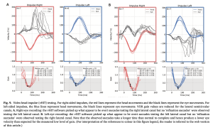 Figure: Video head impulse testing with the camera over the right eye (leftmost two panels) and left eye (rightmost two panels) in a patient with bilateral internuclear ophthalmoplegia. From Koohi et al. (2022).