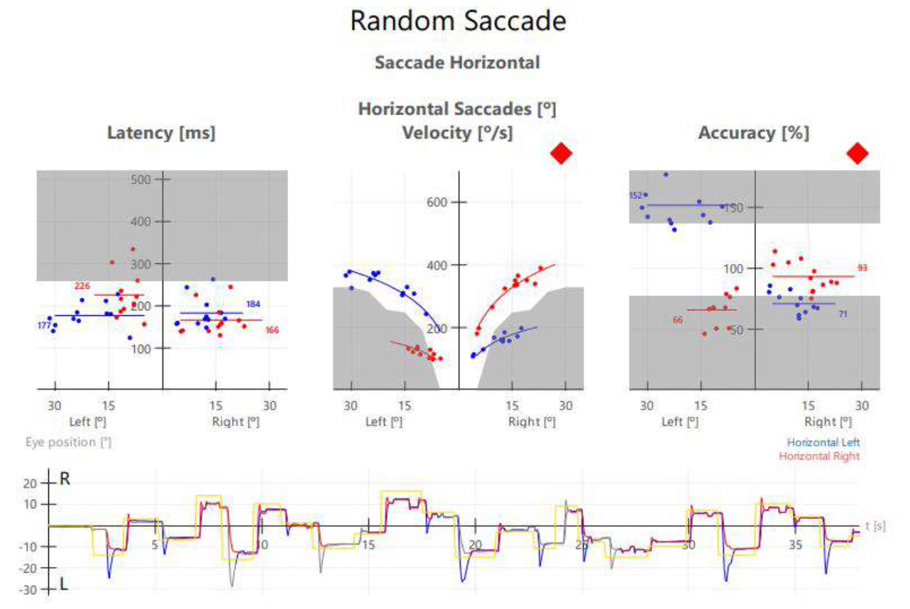 Figure: Oculography of horizontal saccades in the patient with bilateral internuclear ophthalmoplegia.