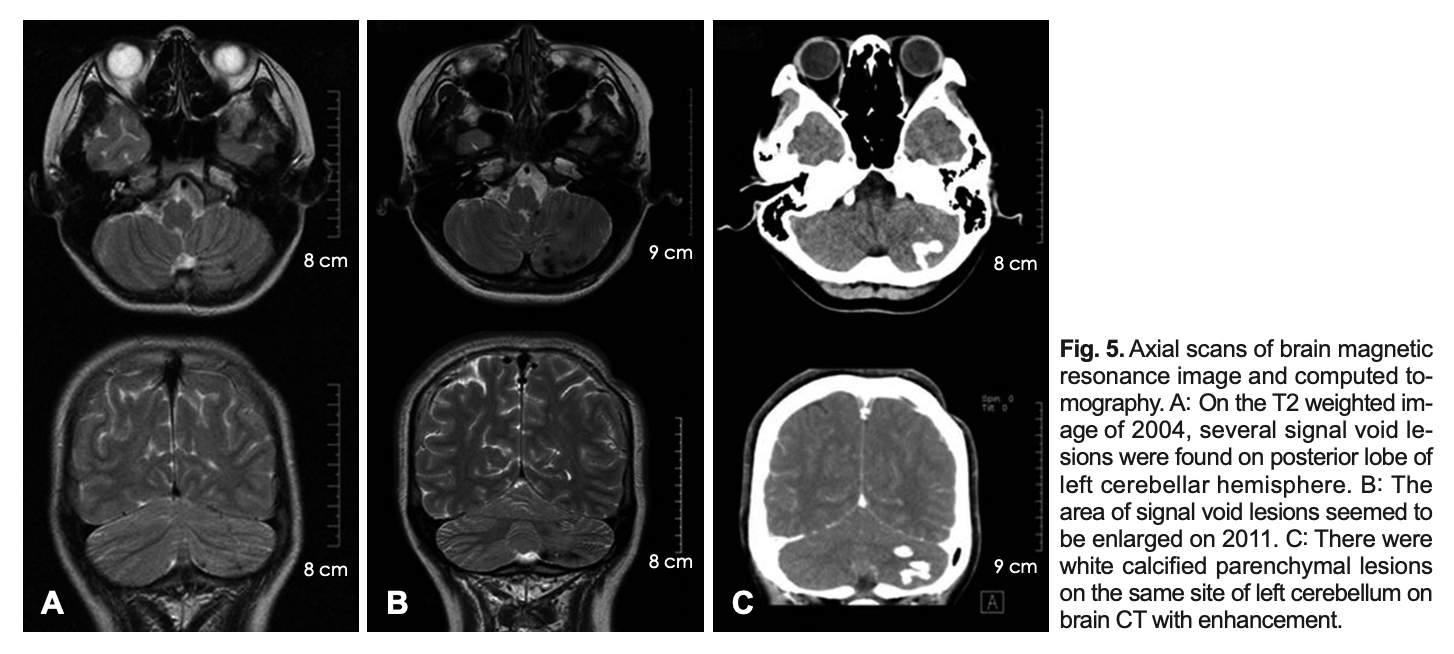 Figure: Brain MRI and head CT of a patient with scleroderma showing intraparenchymal calcification involving the left cerebellar hemisphere.  From Choi et al. (2012).