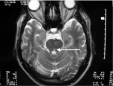 Figure: Brain MRI showing focal area of high T2 signal in the left medial longitudinal fascicles in a patient with left-sided internuclear ophthalmoplegia.  From Deleau et al. (2005).