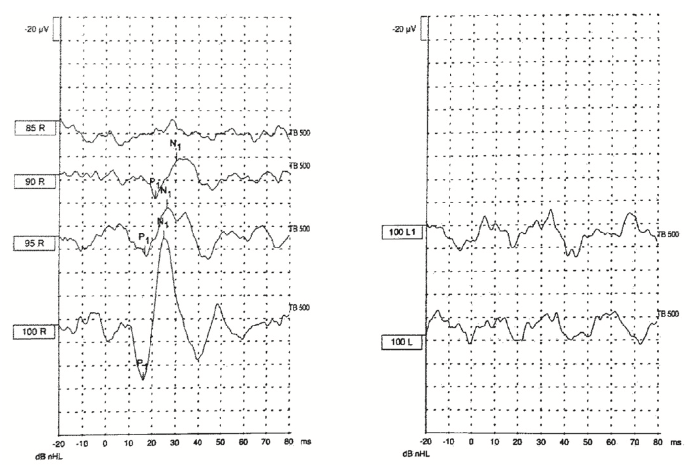 Figure: Cervical vestibular evoked myogenic potentials are absent on the left side in this patient with Susac syndrome.  From Oron et al. (2020).
