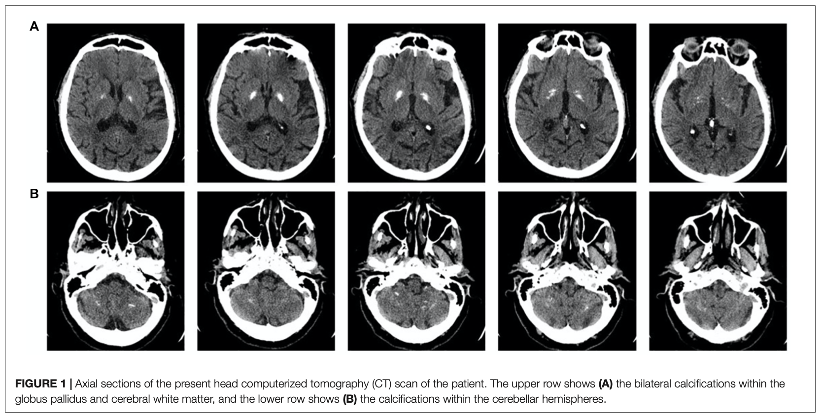 Figure: Head CT of a patient with Fahr disease.  From Scarano et al (2022).