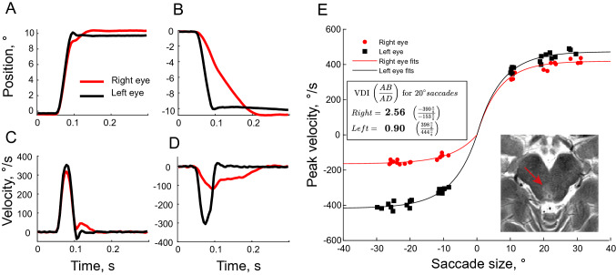 Figure: Ocular motor plots of eye position and velocity, and an MRI demonstrating a lesion involving the right medial longitudinal fasciculus.  From Omary et al. (2023).