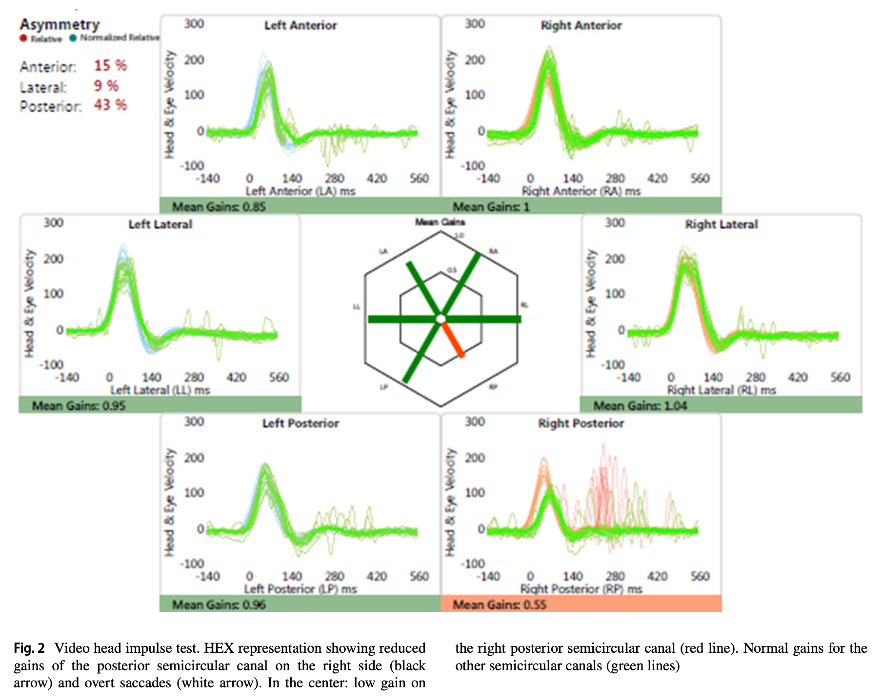 Figure: Right posterior canal deficit (low gain plus overt compensatory saccades) in a patient with Susac syndrome.  From Marrodan et al. (2019).
