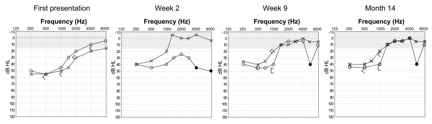 Figure: Serial audiometry showing fluctuating sensorineural hearing loss in a patient with Susac syndrome.  From Hardy et al. (2020).