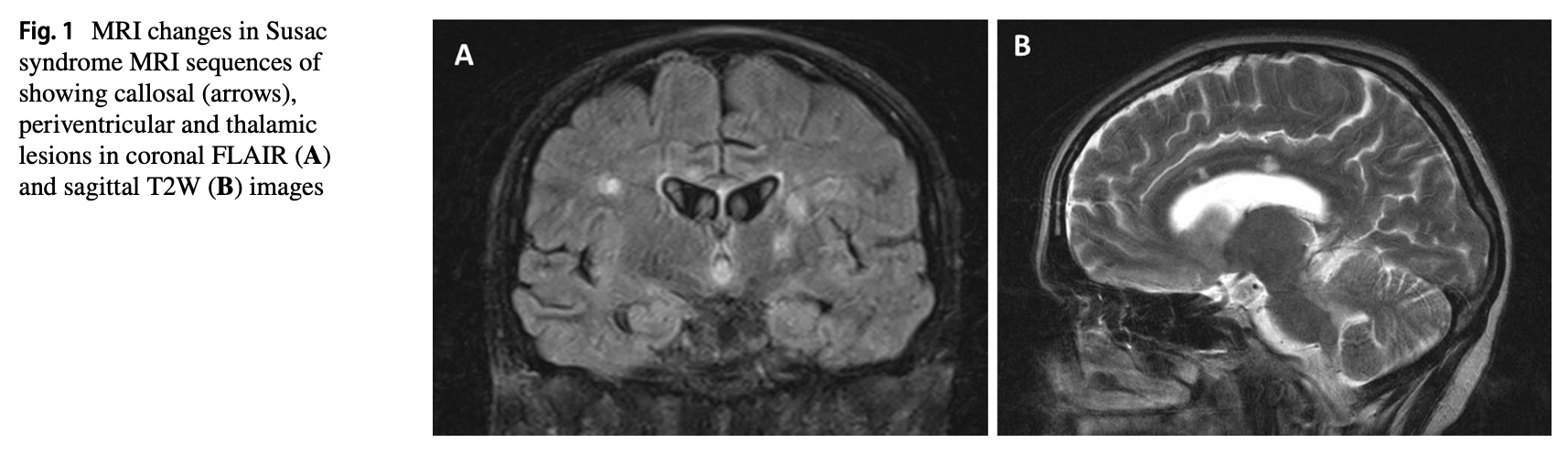 Figure: Typical brain MRI findings in a patient with Susac syndrome.  From Bose et al. (2023).