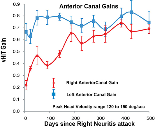 Figure: Gain over time (measured on 12 occasions over 500 days) of the right anterior canal (affected by right-sided vestibular neuritis) and the left anterior canal (healthy). The tracings show clear improvement (approaching normal values) in gain on the side affected by vestibular neuritis. From McGarvie et al. (2020).