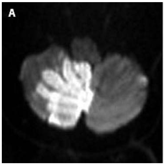 Figure: Acute infarct of the right medial cerebellum in the territory of the right anterior inferior cerebellar artery.  From Horga Hernandez et al. (2006).