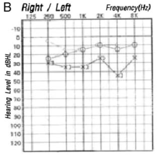 Figure: Audiogram showing left-sided high frequency sensorineural hearing loss in a patient with a left-sided infarction in the territory of the anterior inferior cerebellar artery.  From Lee et al. (2009).