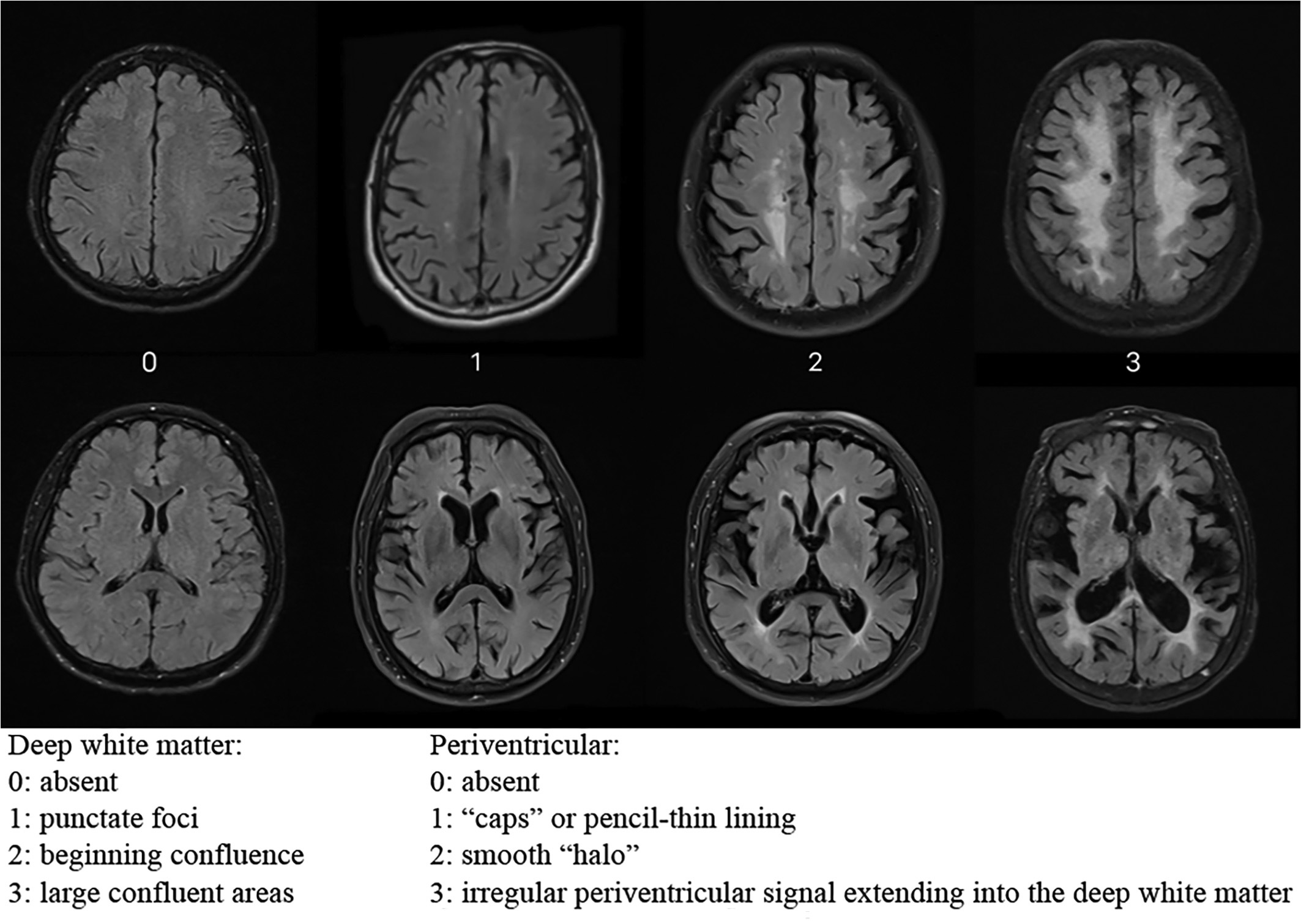 Figure: Different degrees of white matter disease, graded on the Fazekas scale.  From Yu et al. (2023).