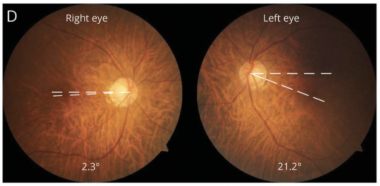 Figure: Fundus photographs from a patient with left-sided vestibular labyrinthine infarction.  This shows leftward cyclodeviation of both eyes.  From Nam et al. (2021).