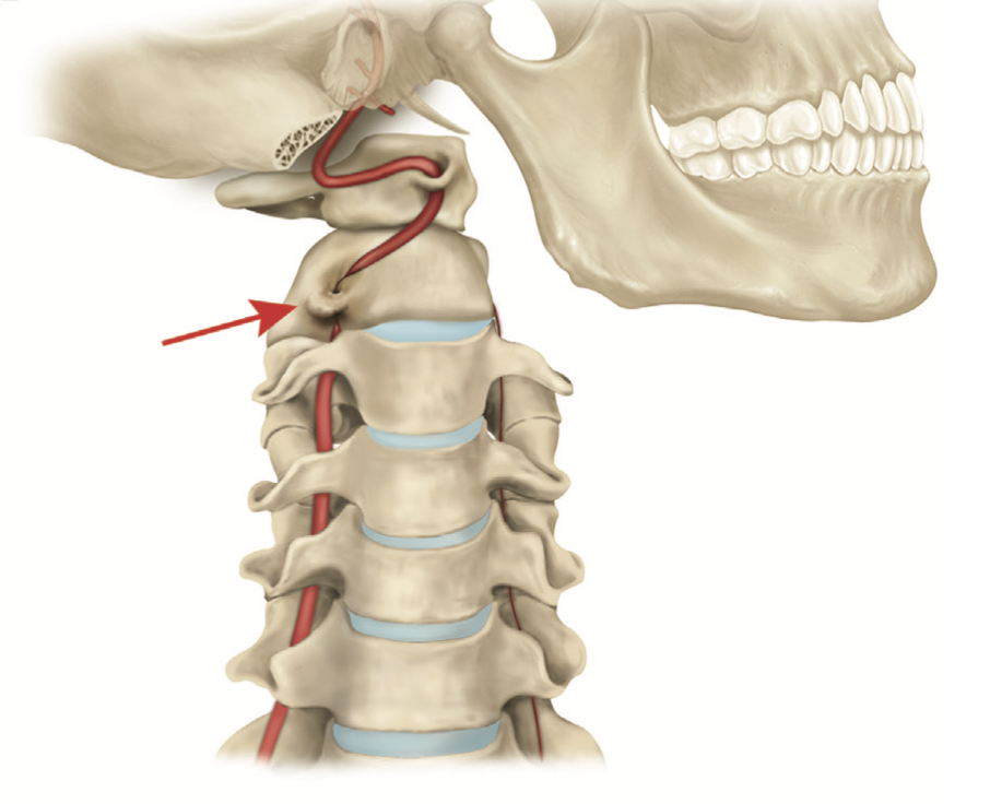 Figure: Stretching and torque exerted on the vertebral artery with head-on-neck rotation.  From Choi et al. (2013).