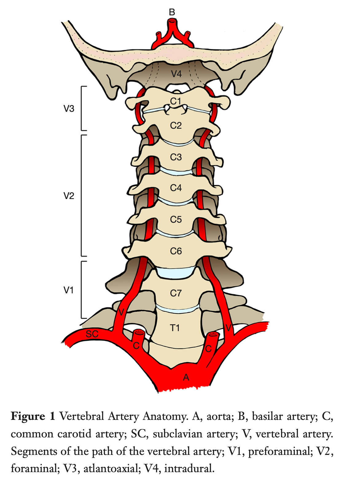 Figure: Vertebral arteries ascend through the cervical vertebral foramina.  From Shafafy et al. (2017).