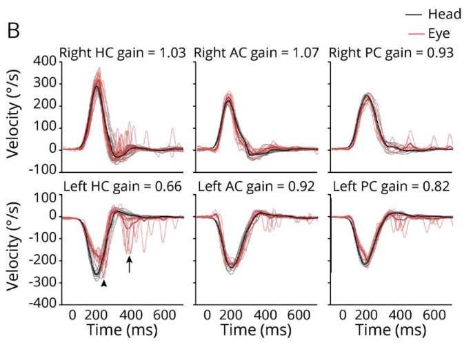 Figure: Video head impulse testing from a patient with left-sided vestibular labyrinthine infarction.  The lower left panel shows results from the left horizontal canal, which exhibits low gain and overt compensatory saccades.  From Nam et al. (2021).