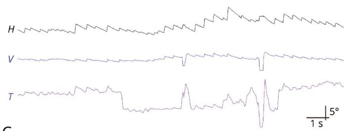 Figure: Video oculographic tracing from a patient with left-sided vestibular labyrinthine infarction shows nystagmus that is predominantly right beat, with more modest components of right torsional and up beat.  From Nam et al. (2021).