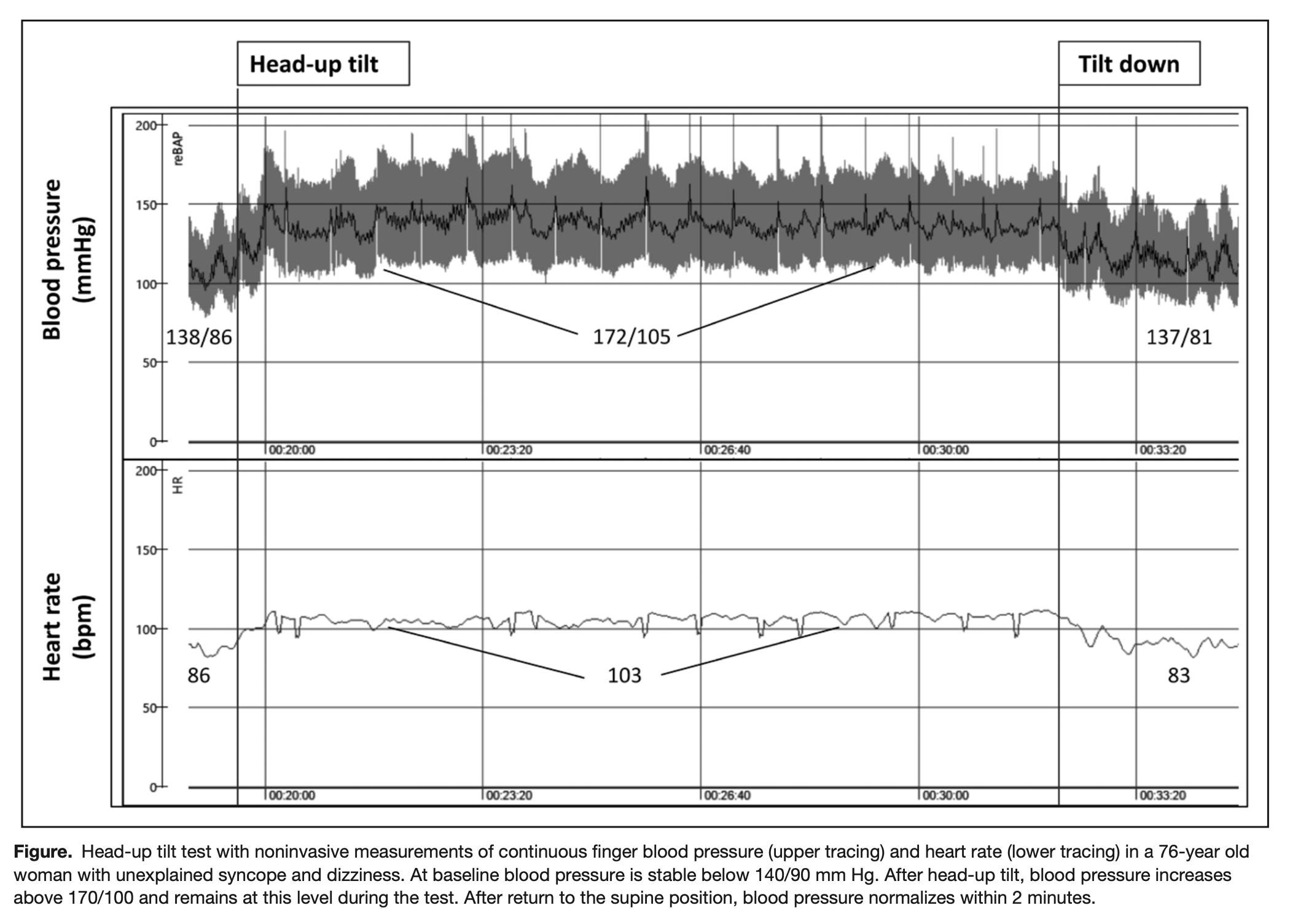Figure: Results from a tilt table test in a 76-year-old woman with orthostatic hypertension.  From Jordan et al. (2020).