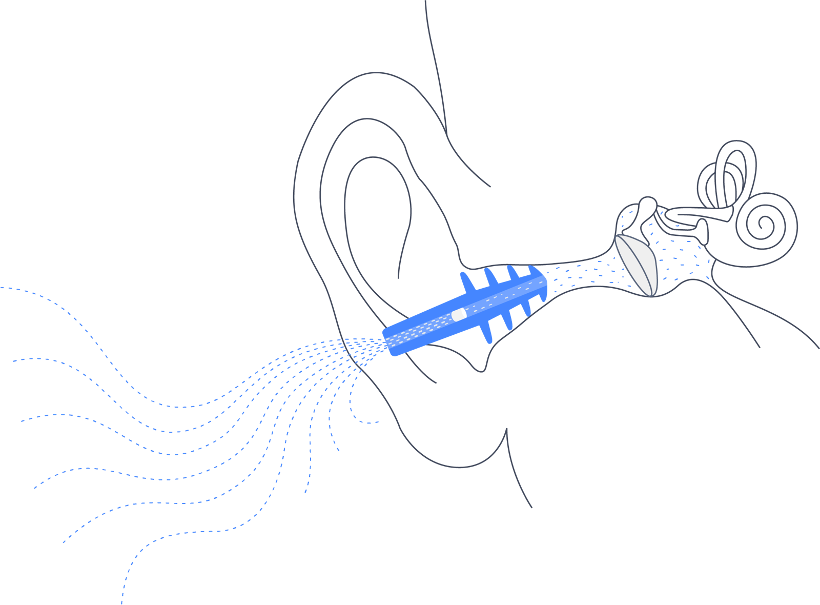 Graphic of EarPlanes in a split view with anatomical drawing of ear, middle ear. Dots representing air pressure going into the earplug and dispersing in the middle ear.