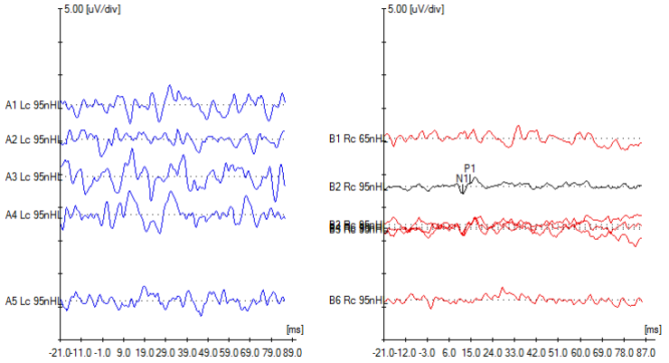 Ocular vestibular evoked myogenic potentials were present on the right with an inter-peak (N1-P1) amplitude of 1.52 microvolts (right side of figure) but absent on the left (left side of figure).