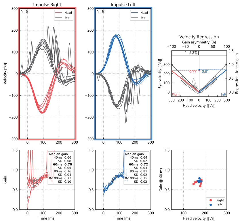 Video head impulse testing showed low gain (0.77 on the right, 0.81 on the left, shown on the right of the figure) and covert compensatory saccades for both horizontal canals (shown in the left and middle of the figure).