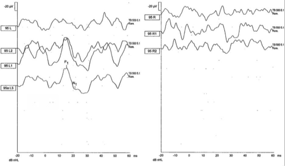 Cervical vestibular evoked myogenic potentials were present on the left with an inter-peak (P1-N1) amplitude of 51 microvolts (left side of figure) but absent on the right (right side of figure).