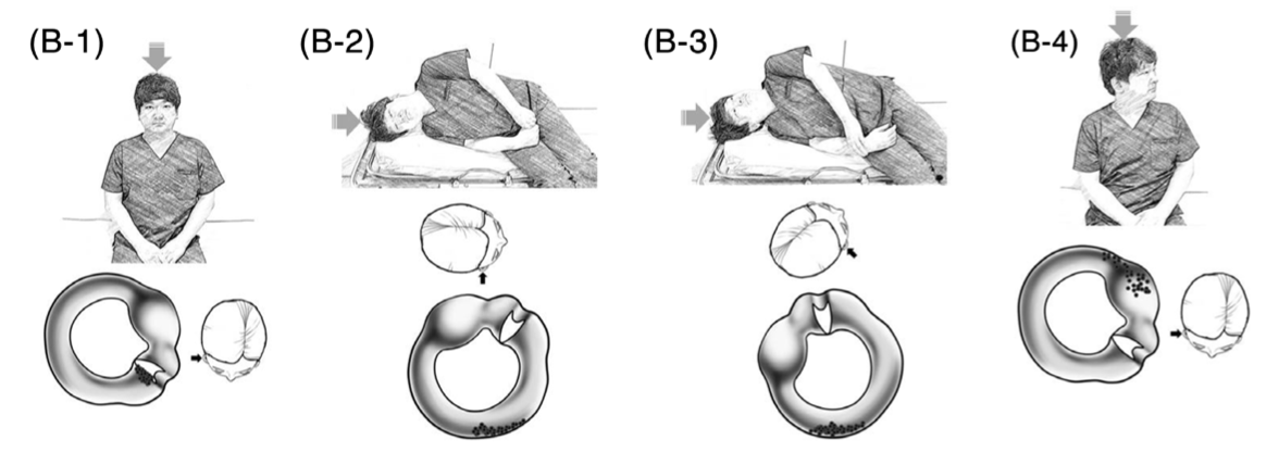 Figure: Gufoni maneuver for right-sided apogeotropic lateral canal BPPV. From Lee et al. (Lee et al. 2021).