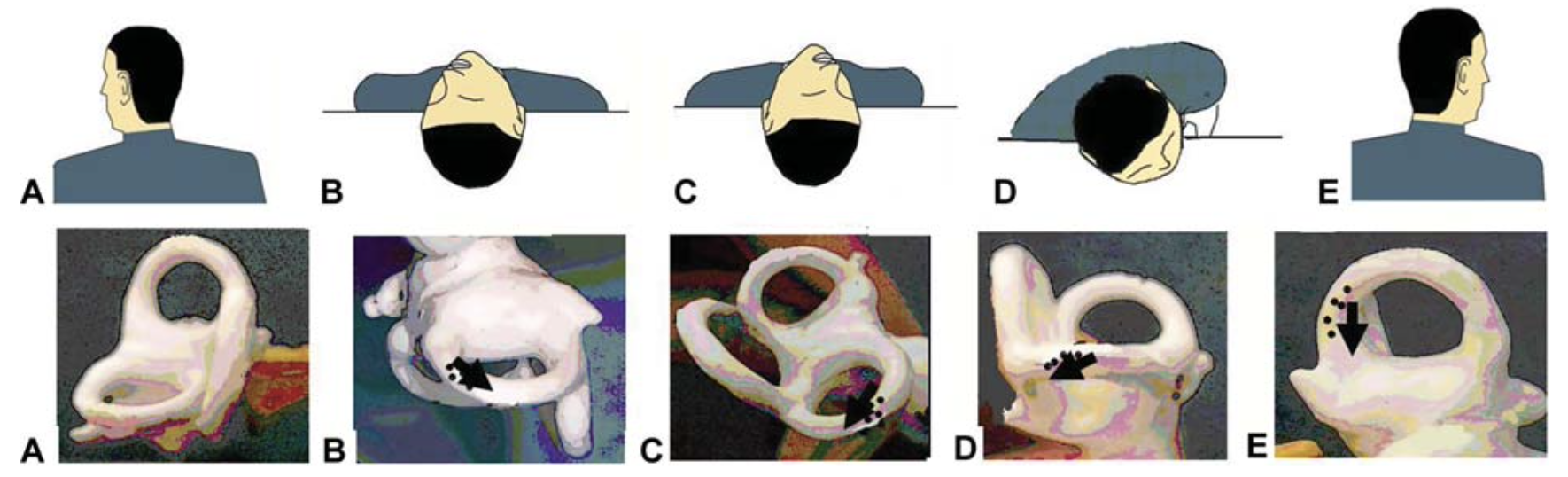 Figure: Reverse Epley maneuver for right-sided anterior (superior) canal BPPV. From Korres et al. (Korres et al. 2010).