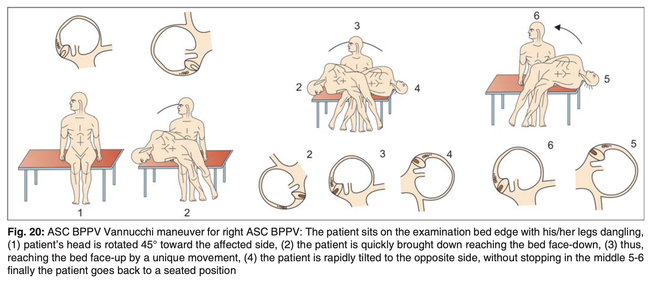 Figure: This figure, from Asprella Libonati (Asprella Libonati 2012), is labeled the “Vanucchi maneuver,” but appears instead to be depicting the modified (reversed) Semont maneuver for right-sided anterior canal BPPV.