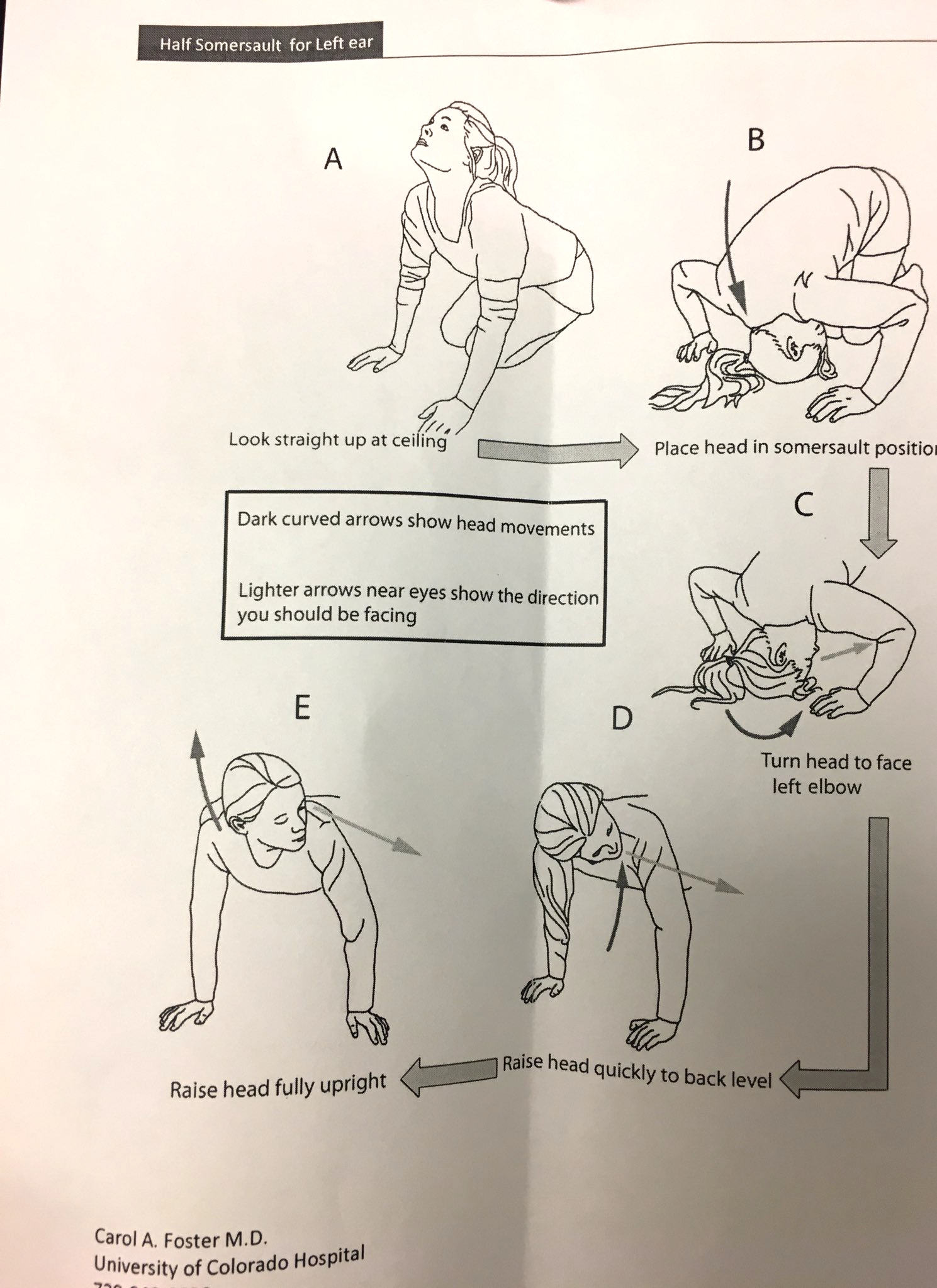 Figure: Left-sided Foster maneuver for treating left-sided posterior canal BPPV. A handout from Dr. Carol Foster.