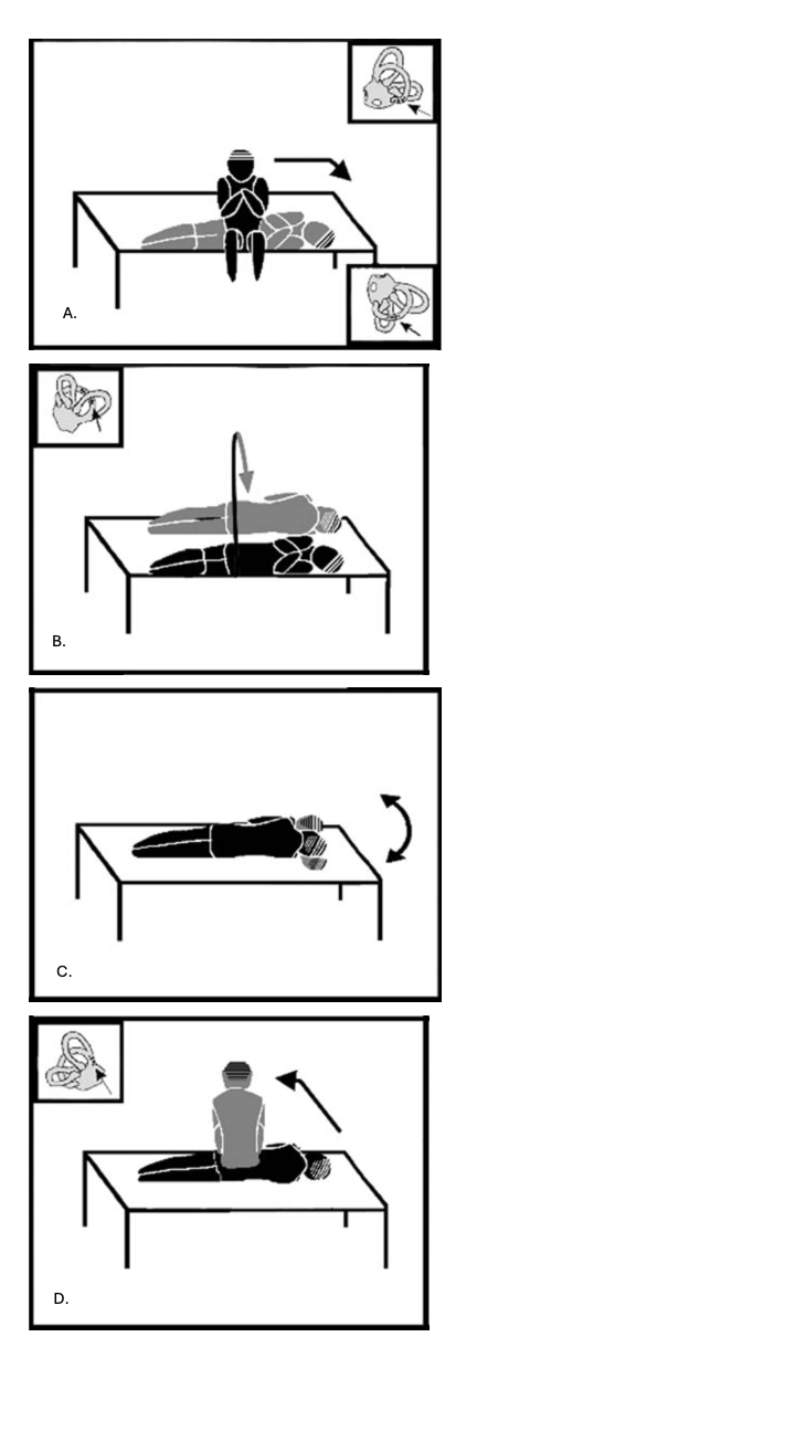 Figure: Gans maneuver for treating left-sided posterior canal BPPV. Modified from Roberts et al. (Roberts et al. 2006).
