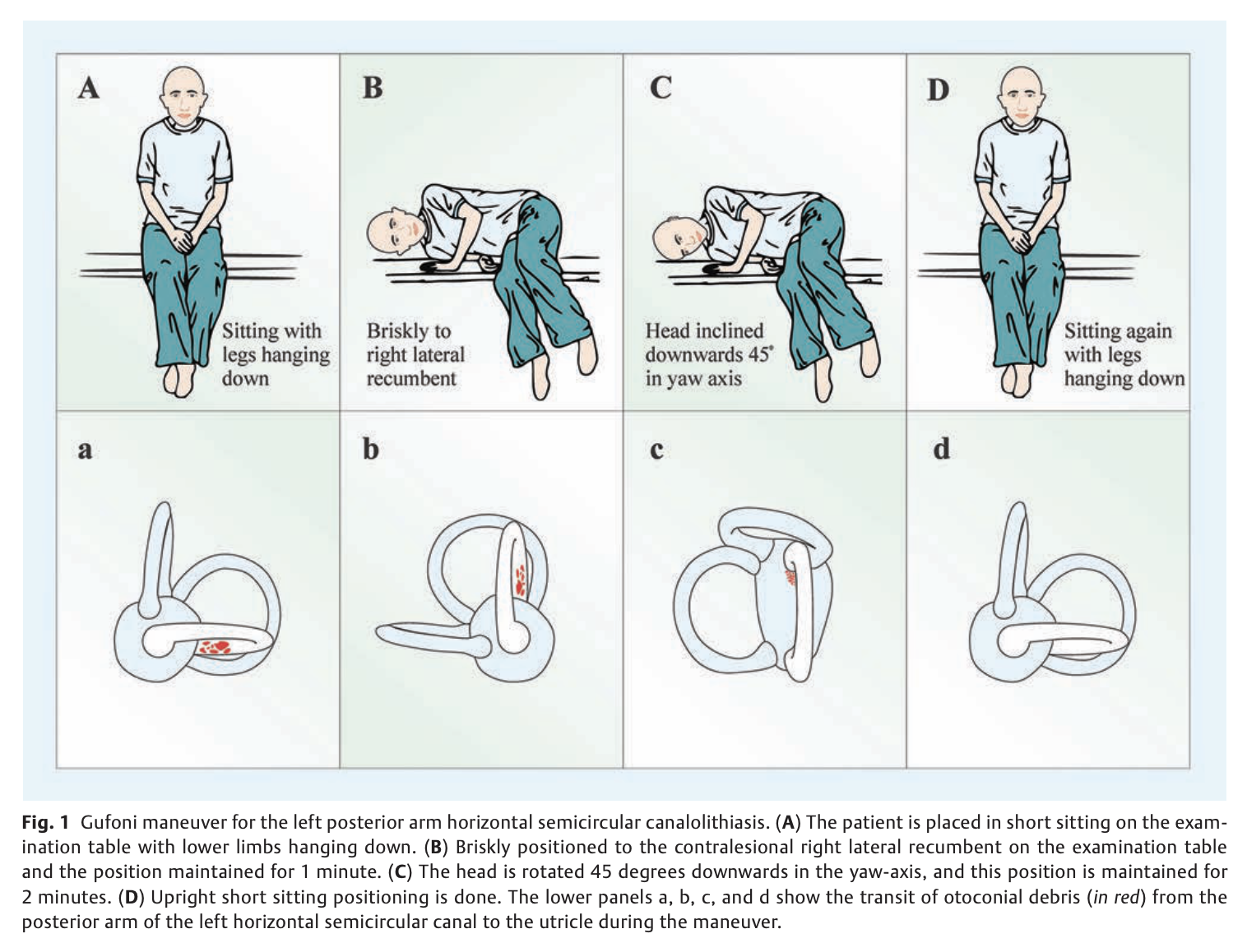 Figure: Gufoni maneuver for left-sided geotropic lateral canal BPPV. From Vats (Vats 2020).