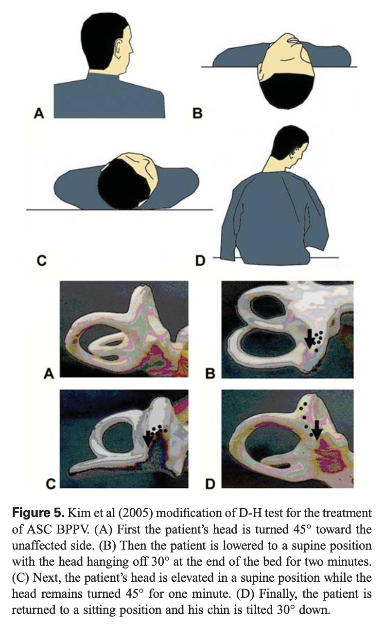 Figure: Kim maneuver for treating left-sided anterior canal BPPV. The perspective is from an examiner standing at the head of the patient’s bed. From Korres et al. (Korres et al. 2010).
