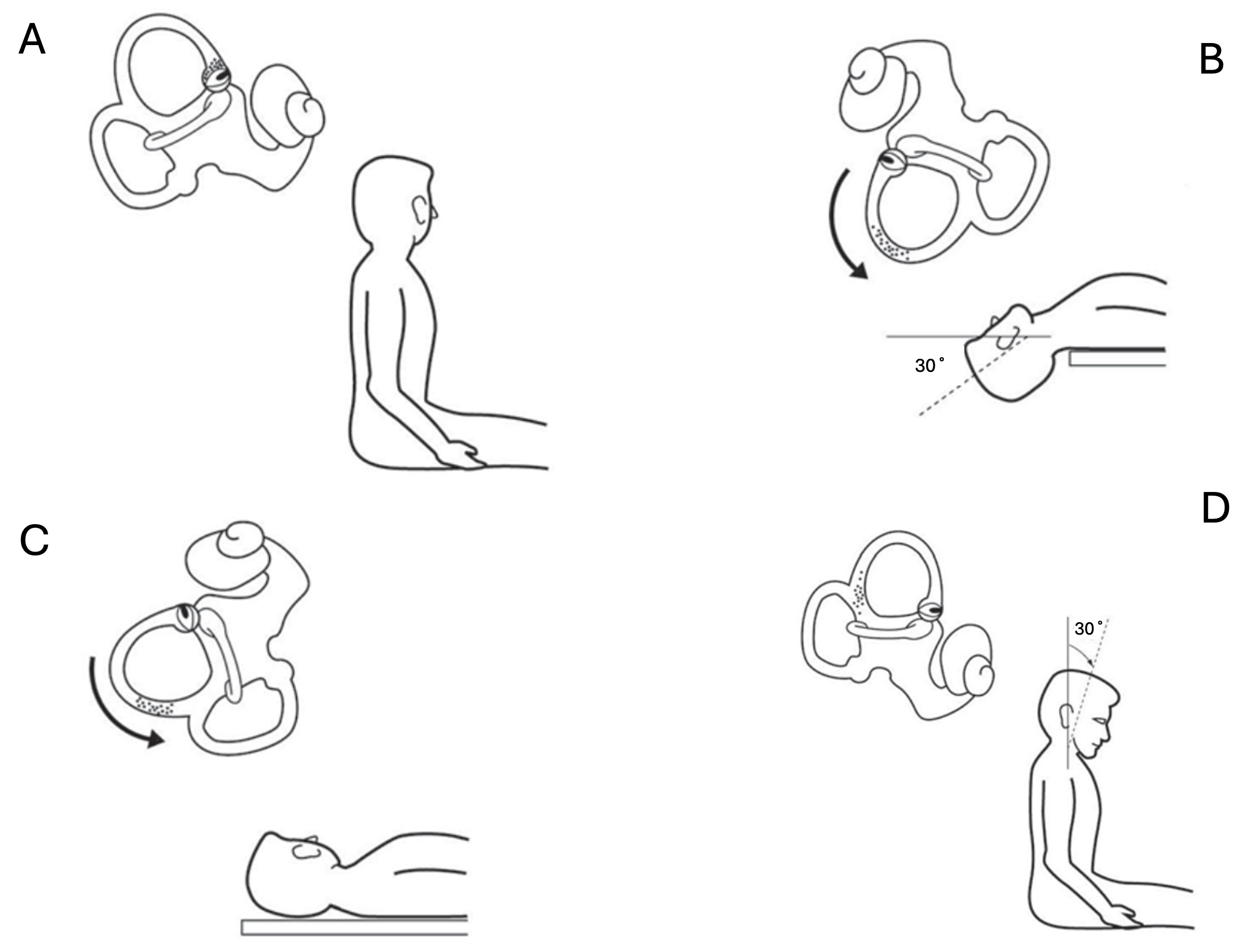 Figure: Kim maneuver for treating right-sided anterior canal BPPV. The perspective is from an examiner standing on the patient’s right side. Adapted from Kim et al. (Kim et al. 2005).