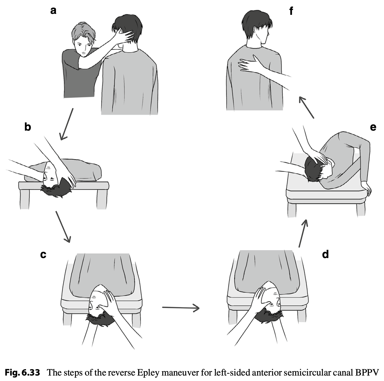 Figure: Supposedly the reverse Epley maneuver for left-sided anterior canal BPPV, from Savas et al. (Savaş et al. 2024). We believe this figure is mistaken.