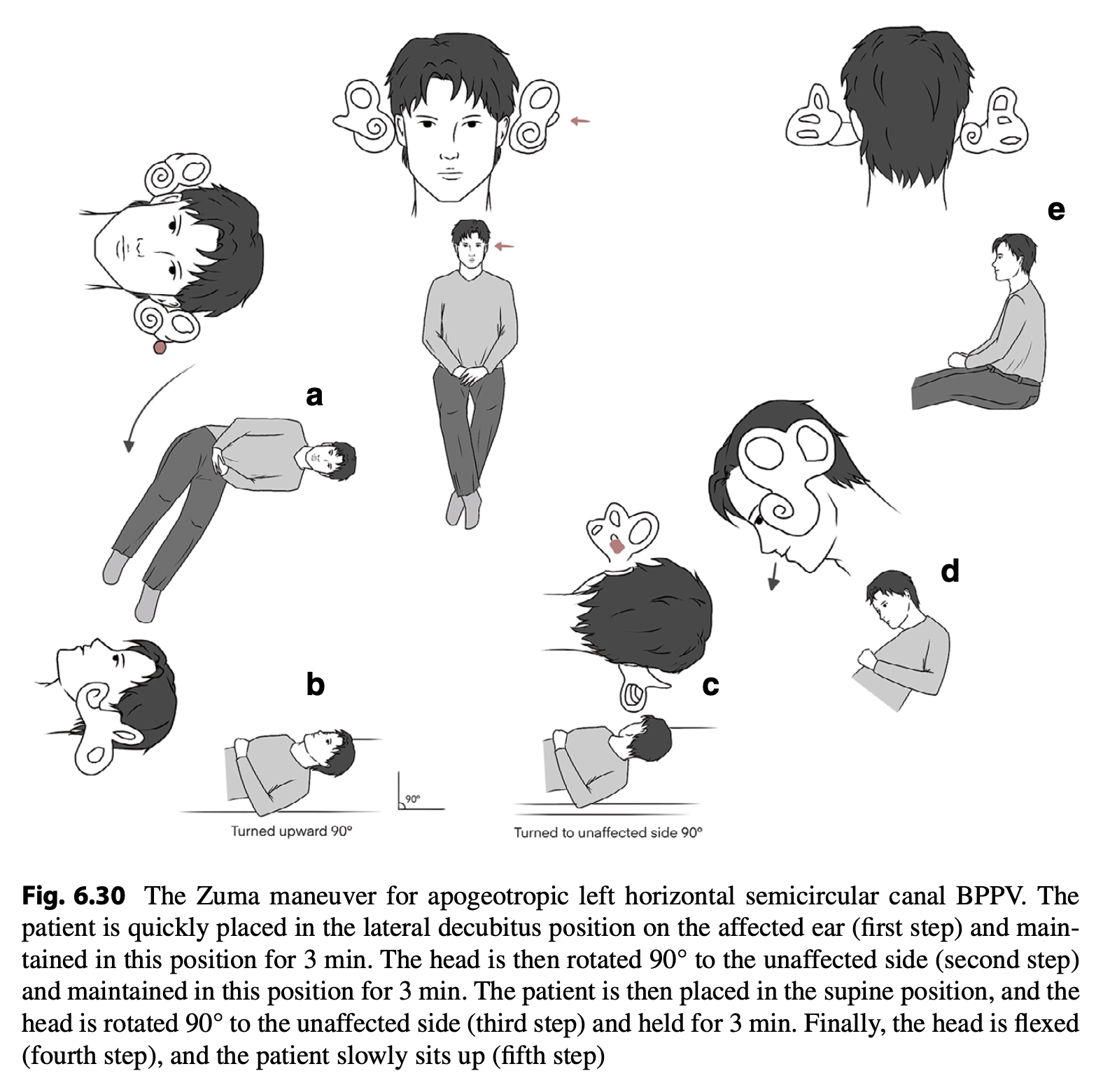 Figure: Left-sided Zuma maneuver for left-sided apogeotropic lateral canal BPPV. From Savas et al. (Savaş et al. 2024).
