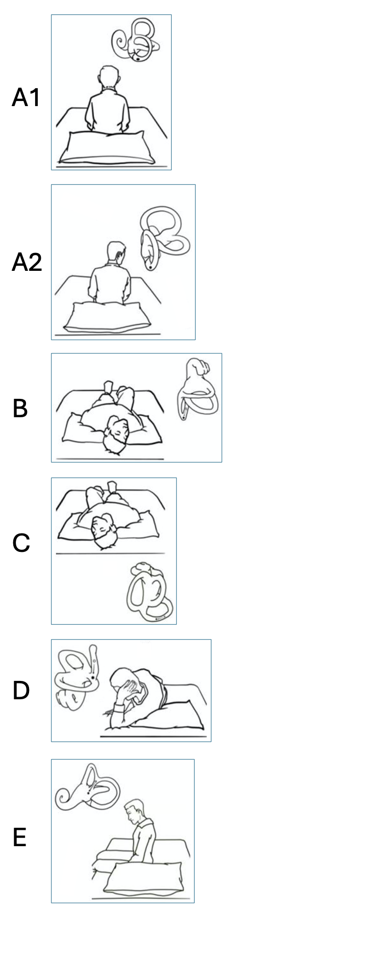 Figure: Modified Epley maneuver for treatment of right-sided posterior canal BPPV. Adapted from Gan et al. (Gan et al. 2021)