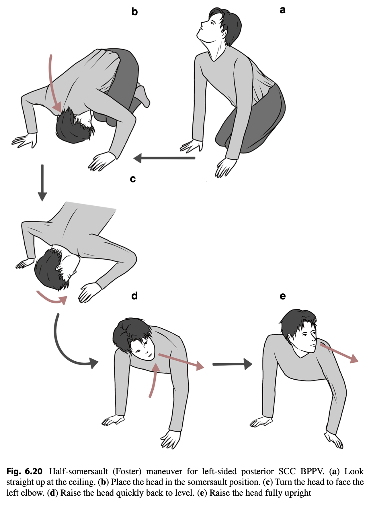 Figure: Left-sided Foster maneuver for left-sided posterior canal BPPV. From Savas and colleagues (Savaş et al. 2024).