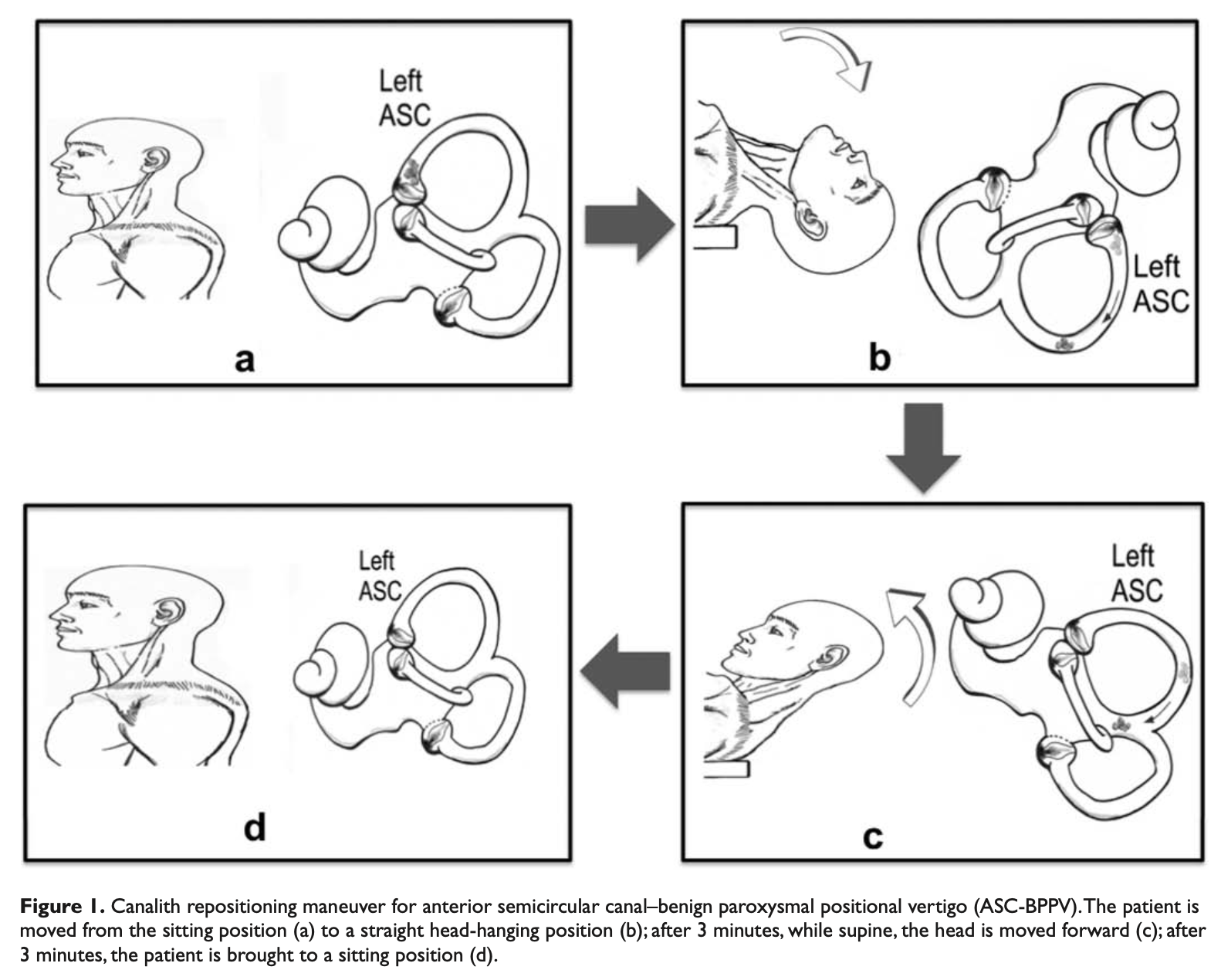 Figure: Casani maneuver for treating anterior canal BPPV when it is bilateral or the side is unknown.  From Casani et al. (2011).