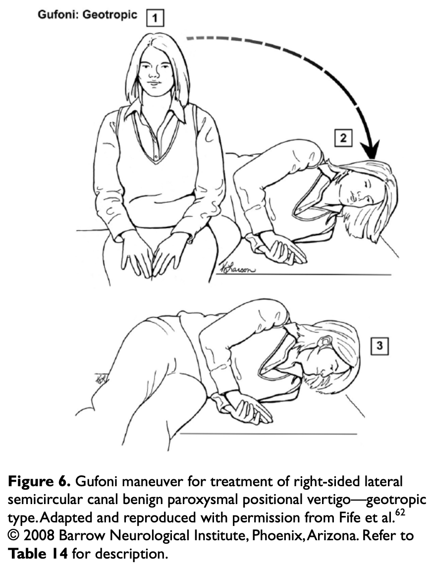 Figure: Gufoni maneuver for right-sided lateral canal BPPV, geotropic variant.  From Bhattacharyya et al. (2017).