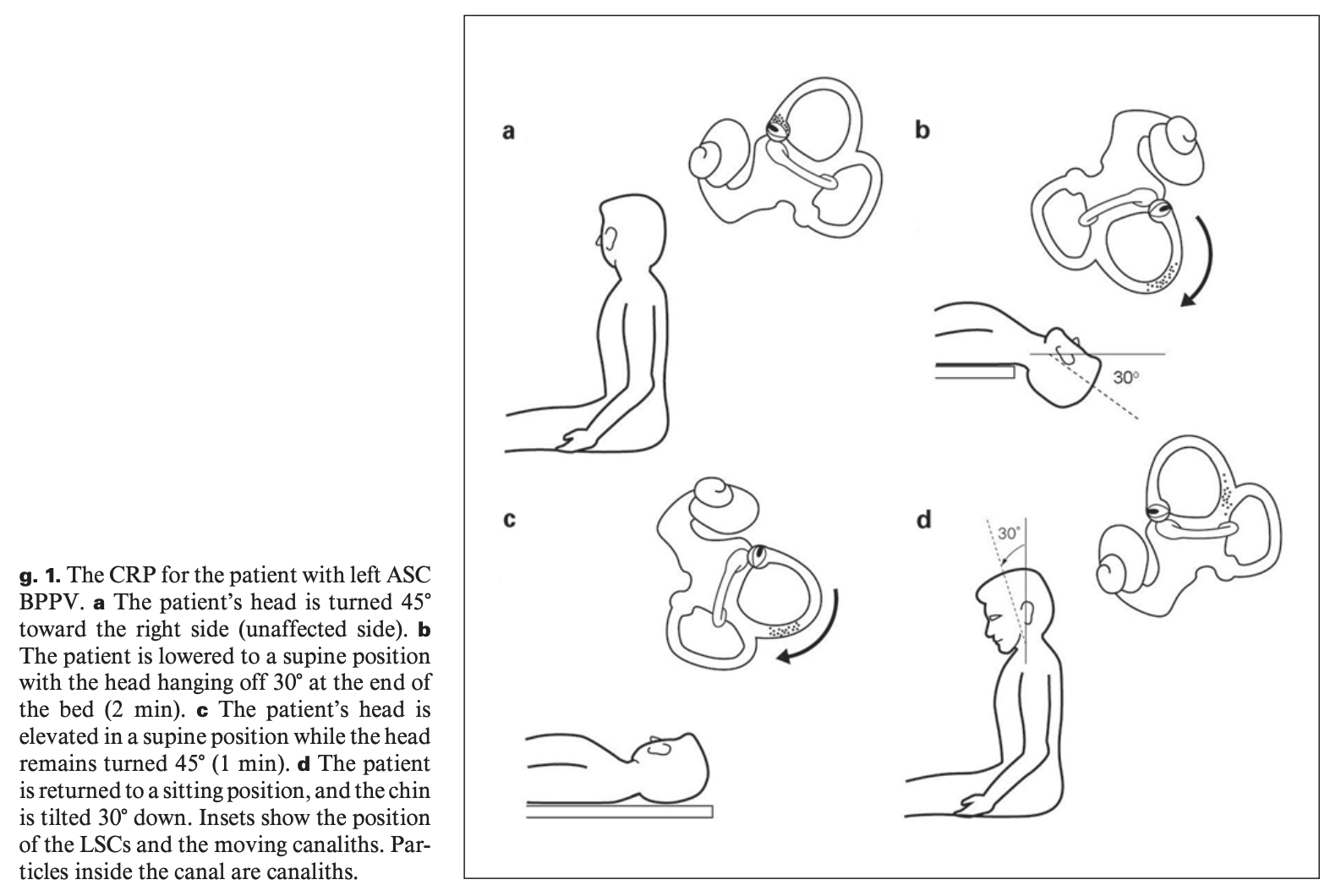 Figure: Kim maneuver for treating left-sided anterior canal BPPV.  From Kim et al. (2005).