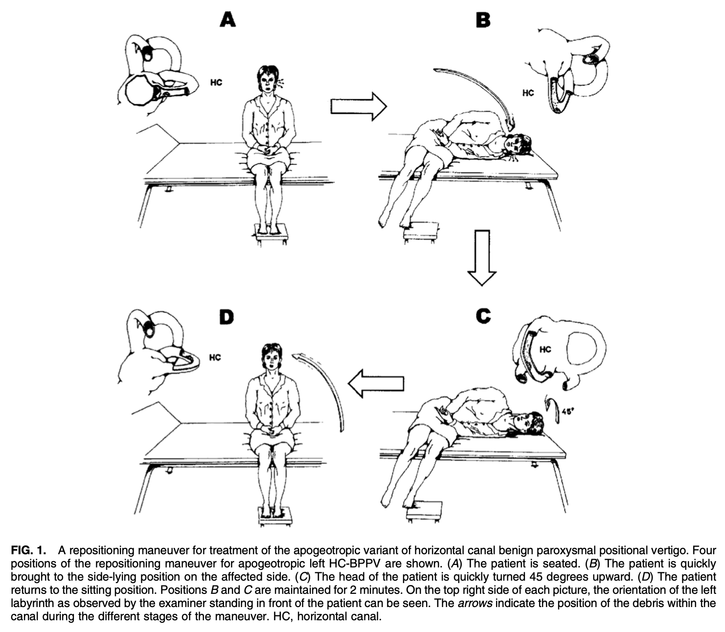 Figure: Left-sided Appiani maneuver for left-sided lateral canal apogeotropic BPPV.  From Appiani et al. (2005).