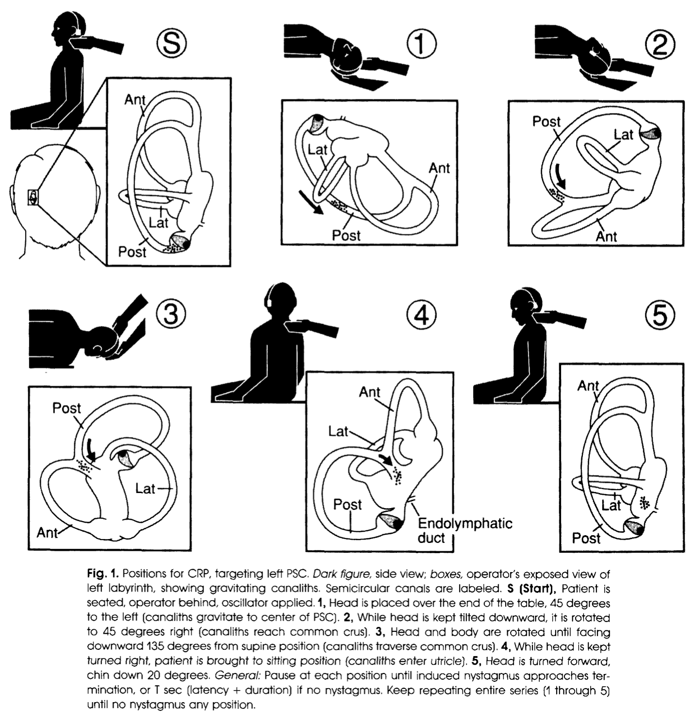 Figure: Left-sided Epley maneuver for left-sided posterior canal BPPV, as illustrated in Epley's original paper (1992).